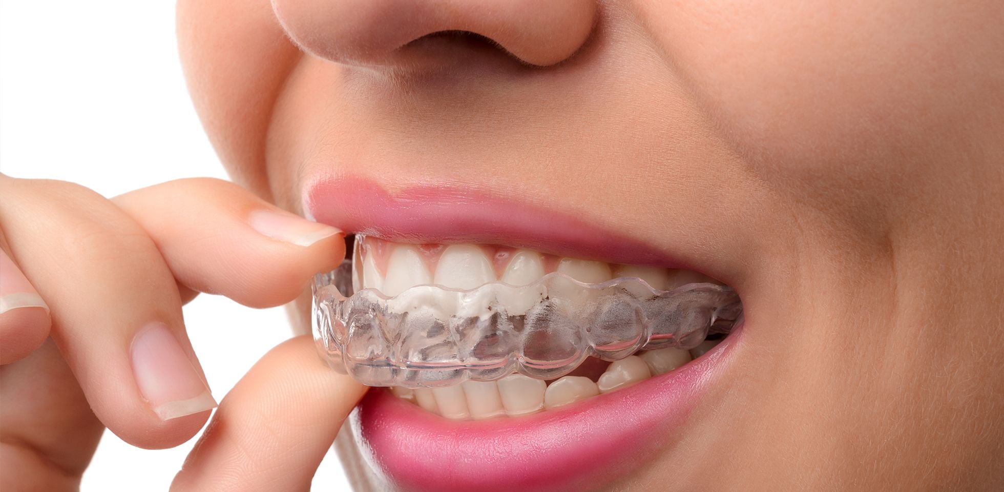 Braces Vs Invisalign - Summit Dental & Orthodontics